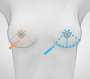 chirurgie poitrine reduction poitrine schema