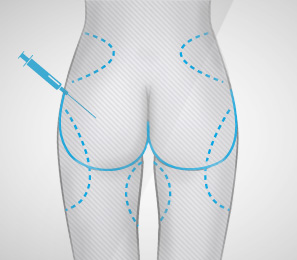 Augmentation des fesses : brazilian butt lift