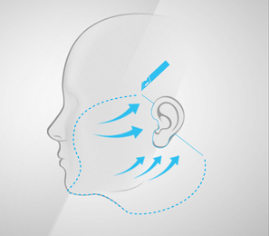 Intervention : lifting cervicofacial (effet anti-âge)