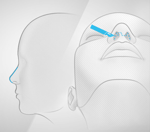 Rhinoplastie ouverte : l'intervention